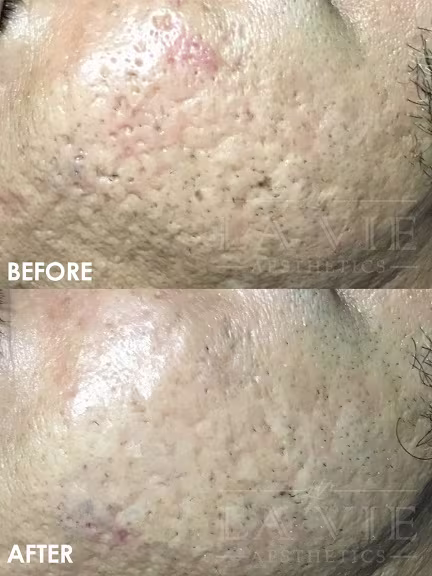 MRF (RF Microneedling) Promotion